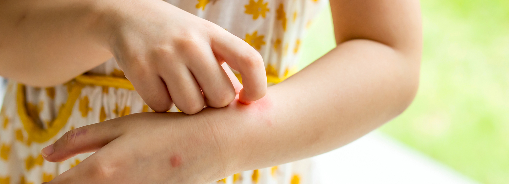 Little girl itching and scratching mosquito bites on her arm